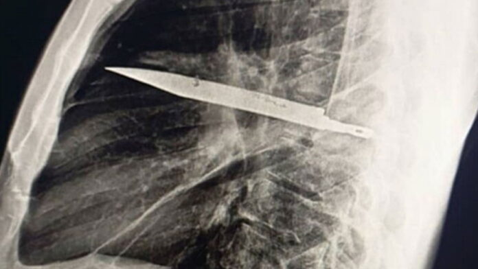 zyl-osiem-lat-z-nozem-w-klatce-piersiowej